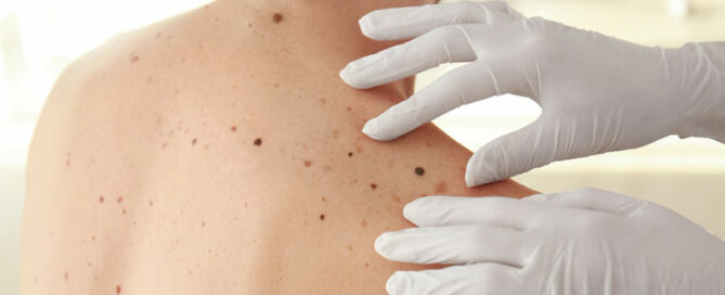 Pembrolizumab Success Rate by Melanoma - Illustration